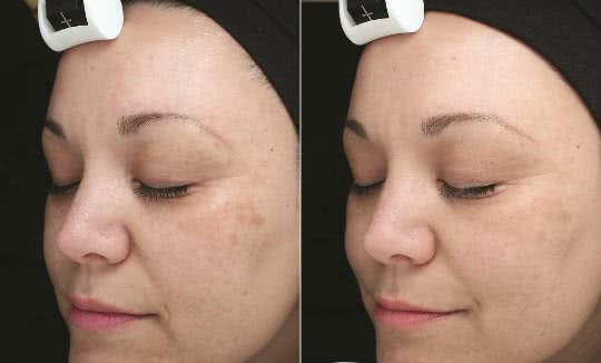 Dermalogica PowerBright Before-and-After You Have to See to Believe